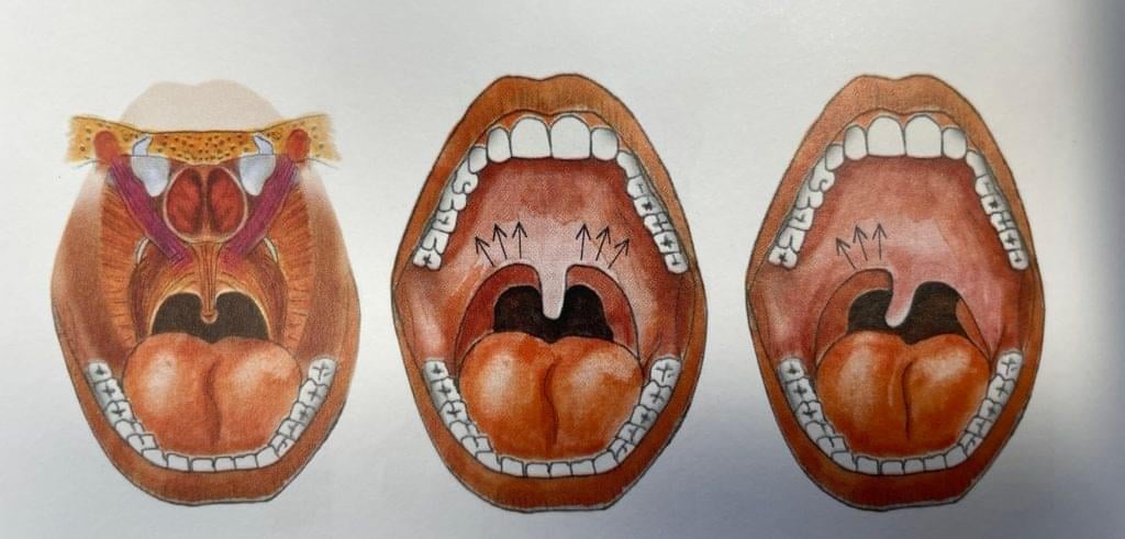 Uvula Deviation Test